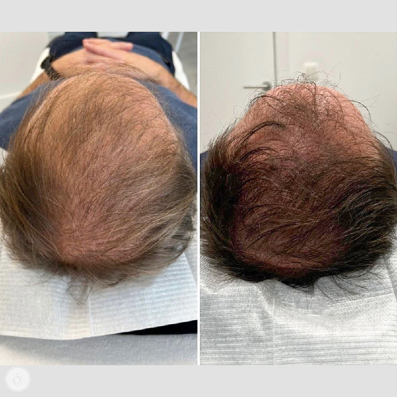 Haarfillers kruin voor en na haarverlies