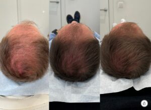 haaruitval mannen testosteron sarasin clinic