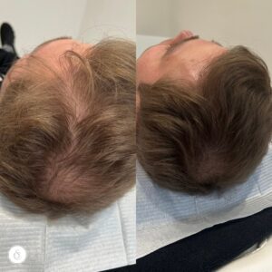 haartransplantatie kosten sarasin clinic