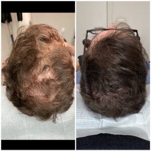 haartransplantatie voor en na