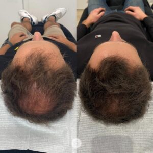 haartransplantatie gent sarasin clinic