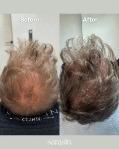haarfillers_reviews_ervaringen_beveren